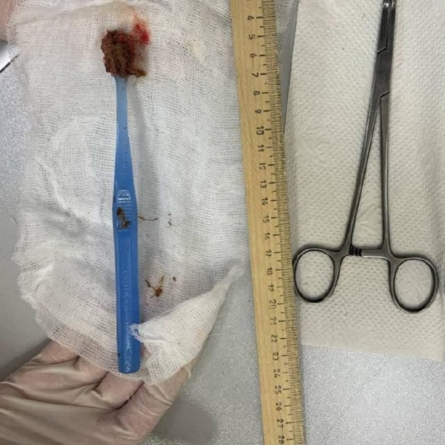 18-сантиметровую щётку для чистки брекетов проглотила школьница из Нижневартовска