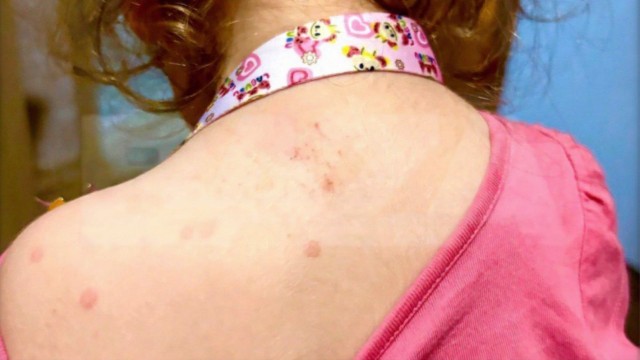 Вирус Коксаки массово поражает детей по всей России — родители бьют тревогу и жалуются, что болезнь приносят из детских садов.