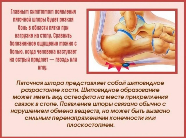 Россиянка слишком много ходила в отпуске и буквально «сломала» обе пятки