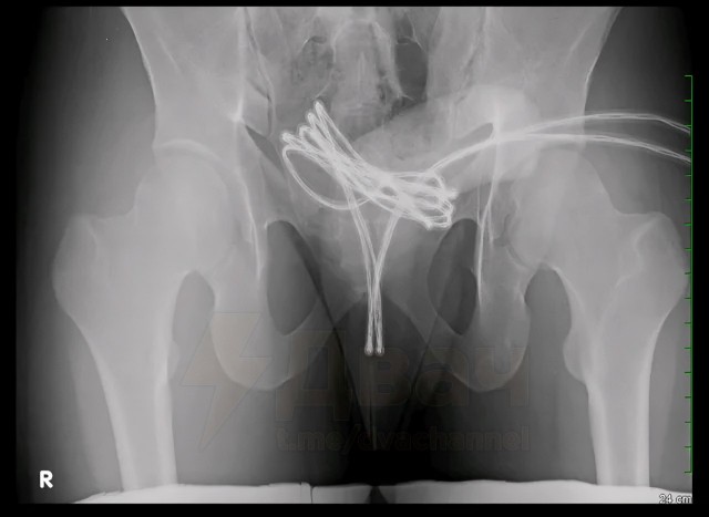 21-летний американец засунул себе в уретру USB-кабель