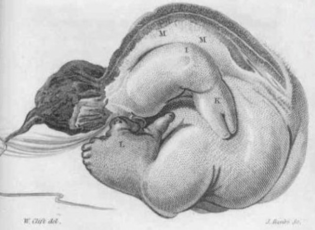 Самые неожиданные вещи, найденные в теле человека