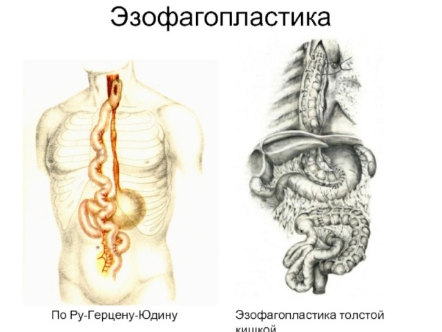 Метод переливания трупной крови по Юдину