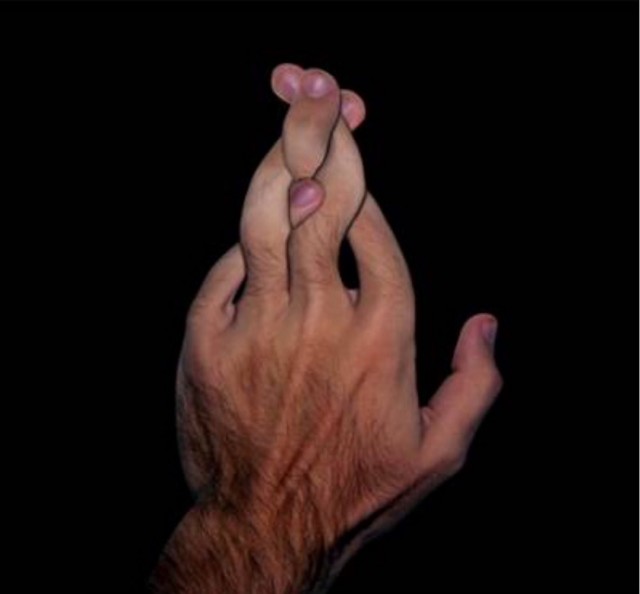 Шрамы на пальце - есть у всех? У меня даже два!