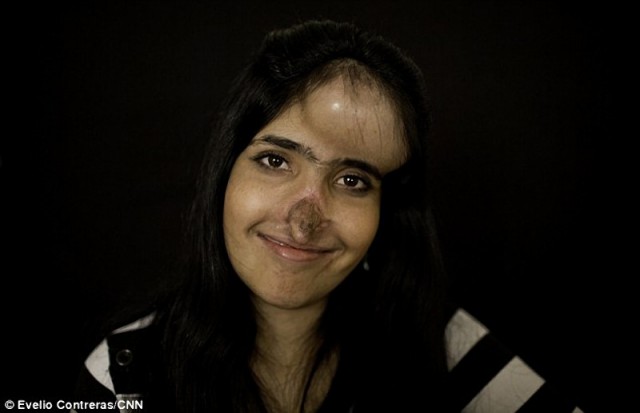 Афганской девушке Аише сделали новый нос