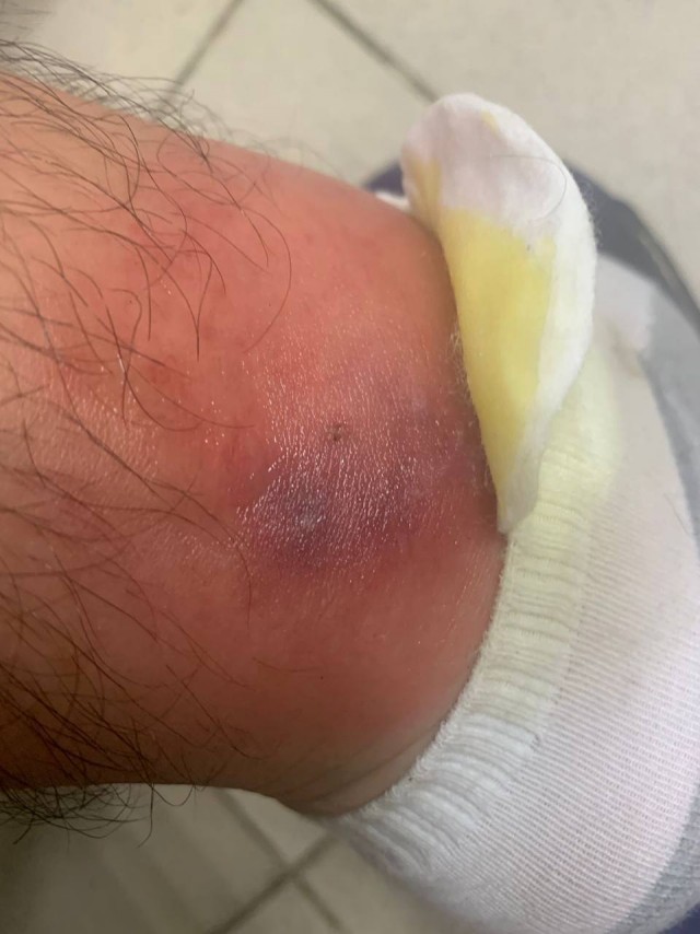 Подросток из Пушкино сутки скрывал от родителей укус змеи