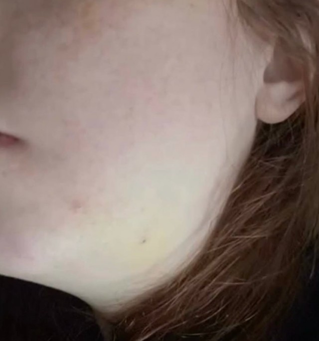 Жительница Подмосковья попала в реанимацию с абсцессом после удаления зуба мудрости в частной клинике