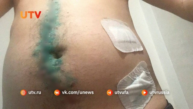 Уфа: парочка на самокате сбила прохожего. Его пришлось экстренно оперировать