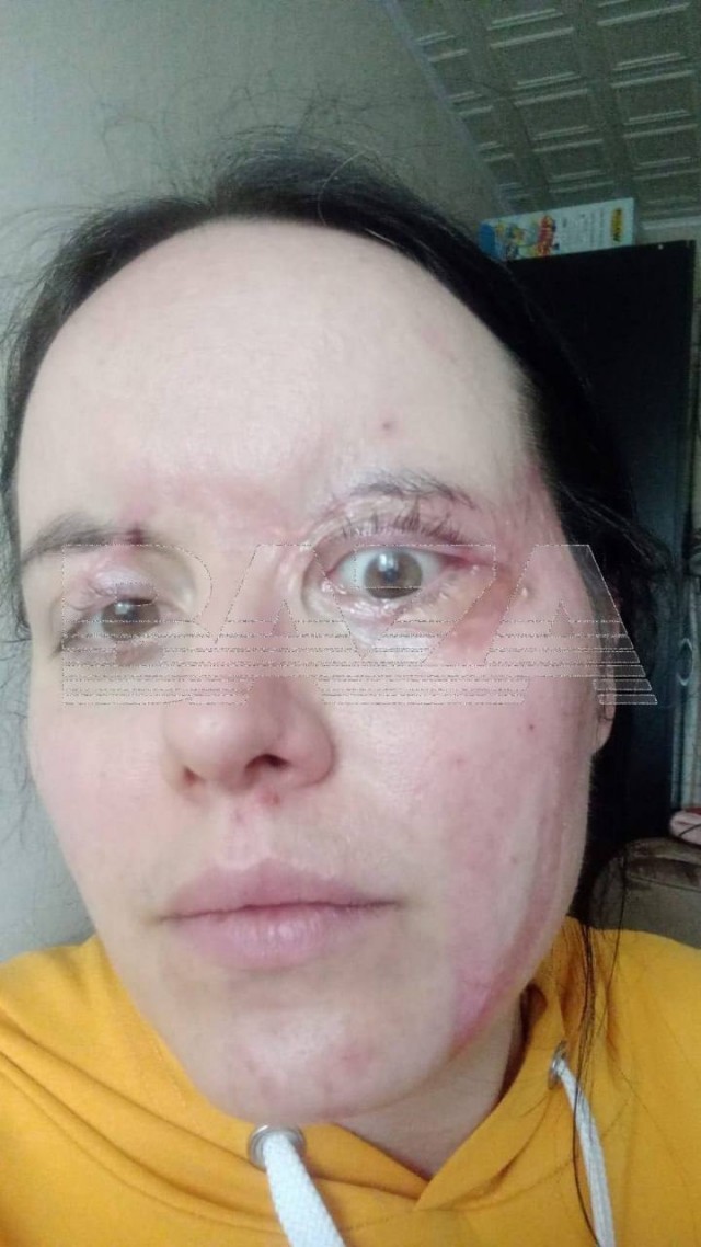 Кислотный маньяк из Монино через суд хочет снизить размер выплат своей жертве