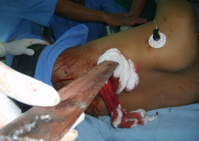 Португальский парень чудом выжил, после того как его проткнуло железякой