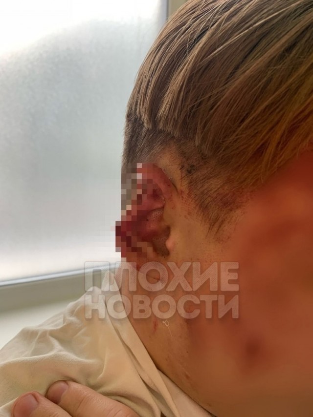 В Новокузнецке дикие мигранты отгрызли ухо и нос двоим парням, которые заступились за подростка