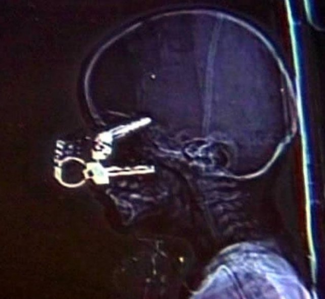 Самые неожиданные вещи, найденные в теле человека