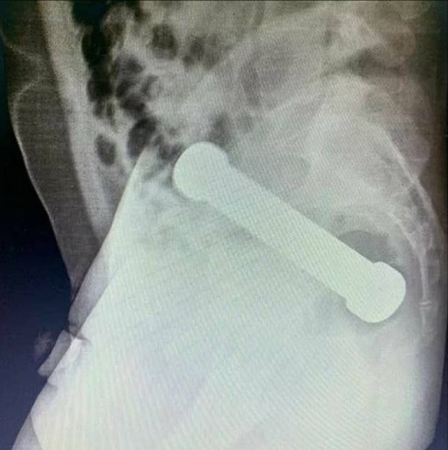 Мужчина сутки ходил с кабачком в заднем проходе