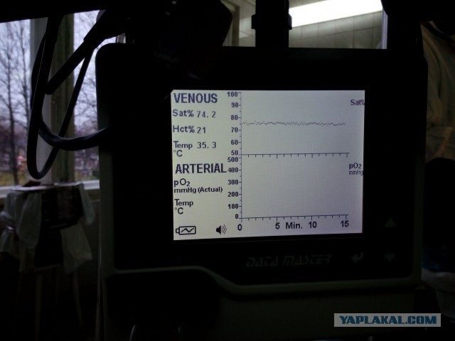 Искусственное кровообращение