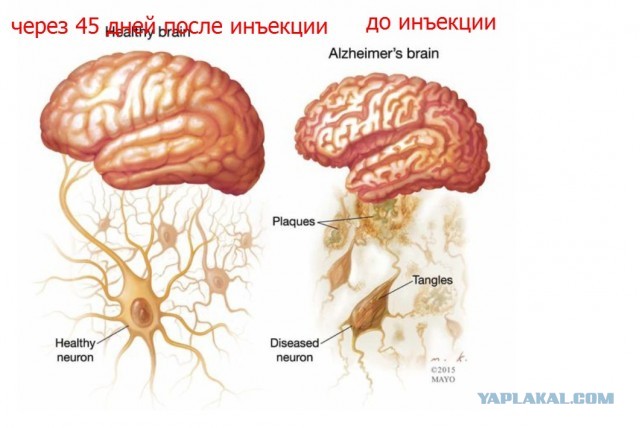 Гениальное открытие: решена проблема болезни Альцгеймера