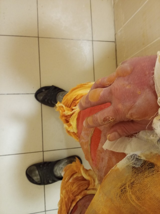 Девушка показала ноги, которые 27 лет назад полностью обварил кипяток из самовара