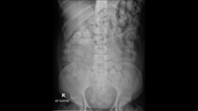 Во Внуково задержали девушку с полкило кокаина в желудке