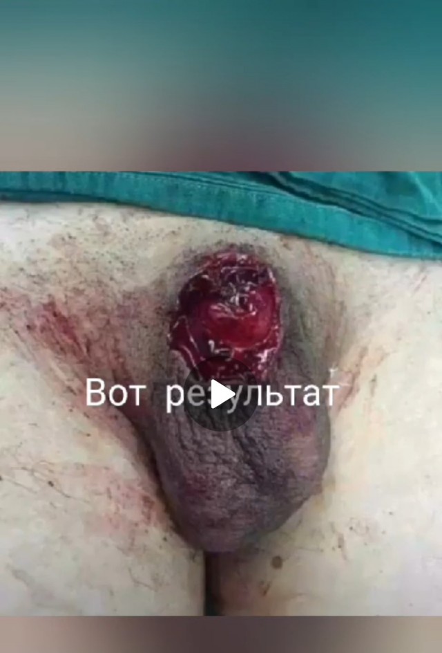 Обрезали лишнего: пермяк судится с клиникой, где неудачно провели деликатную операцию