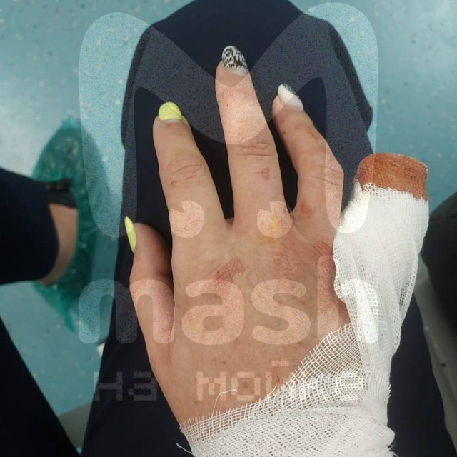 Палец уже не пришить