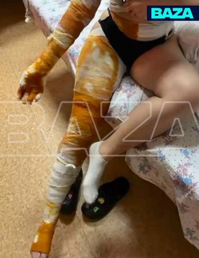 Девушка плеснула в мангал самогон вместо воды и вспыхнула на глазах у жениха — так закончилась годовщина их отношений