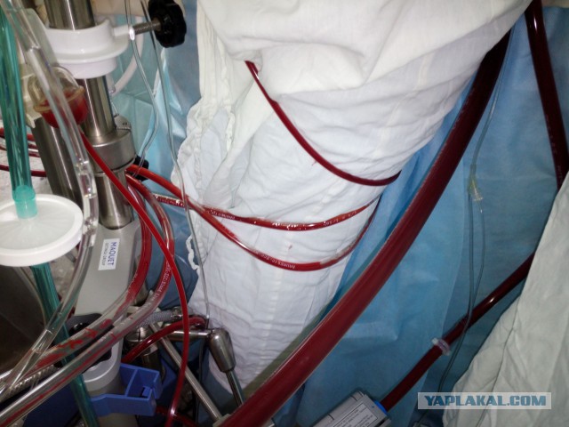 Искусственное кровообращение