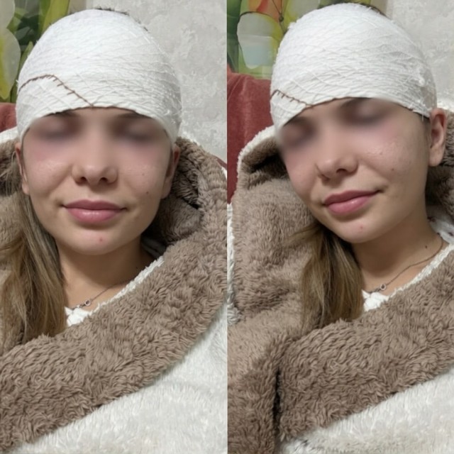 Из-за обычного прыщика россиянке разрезали лоб и положили в больницу.