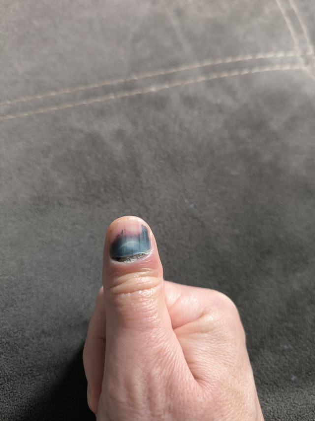 Из жизни одного пальчика