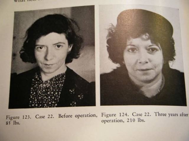 Лоботомия. История потрошения мозгов или Самая постыдная Нобелевская премия