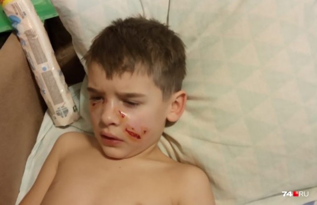 В Челябинске бродячая собака вцепилась в лицо ребенку