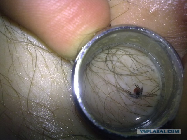 Клещевой энцефалит