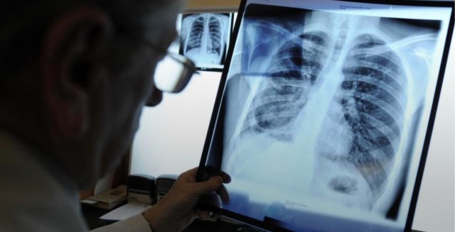 В новосибирской школе среди детей выявили случаи туберкулеза