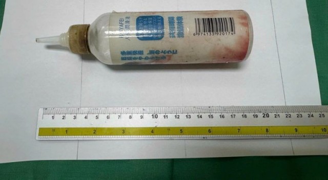 Во Вьетнаме врачи спасли мужчину от странного предмета — это бутылка длиной 20 см и диаметром 5 см в прямой кишке