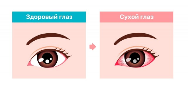 Глаз болит