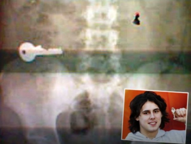 Самые неожиданные вещи, найденные в теле человека