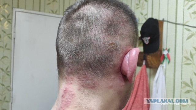 Ветрянка