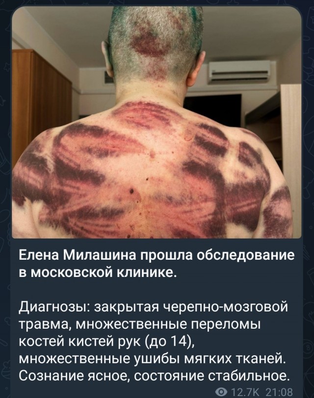 Переломы рассосались — Милашина и Немов уже в московской больнице