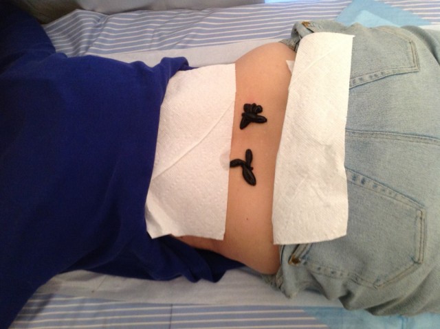 Герудотерапия