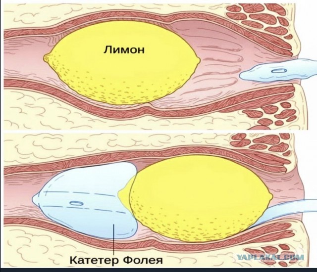 Трагическая подсечка от стакана зафиксирована в Уфе