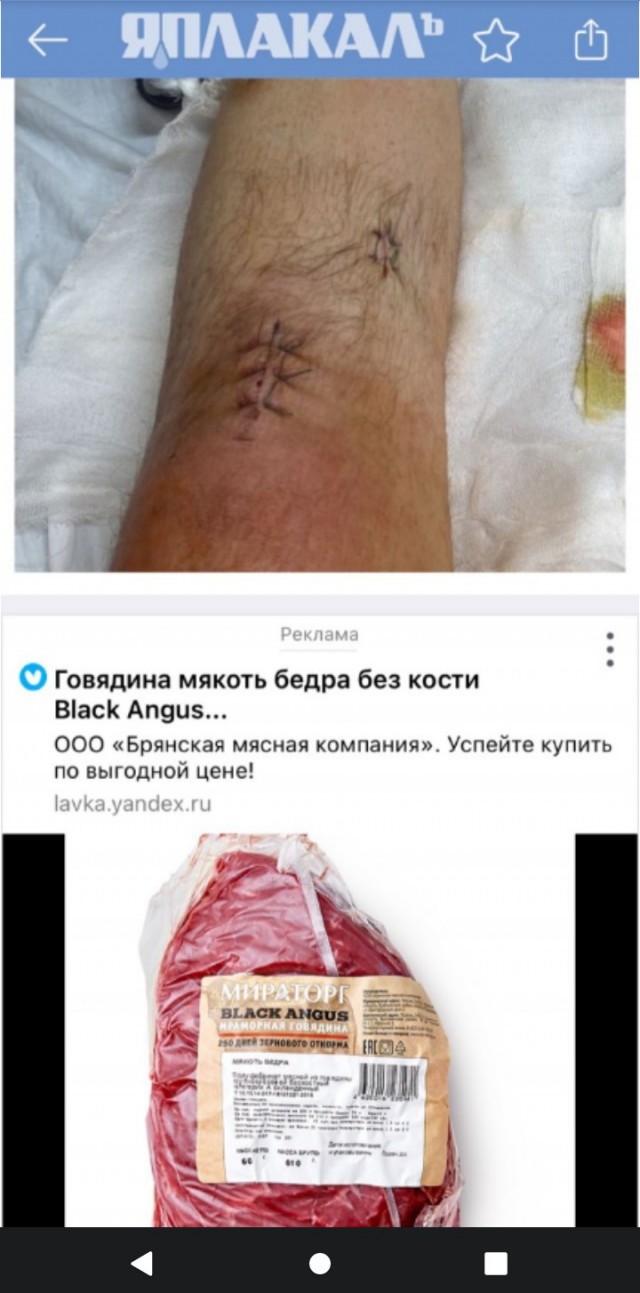Сказ о том, как я шел домой и сломал ногу в двух местах