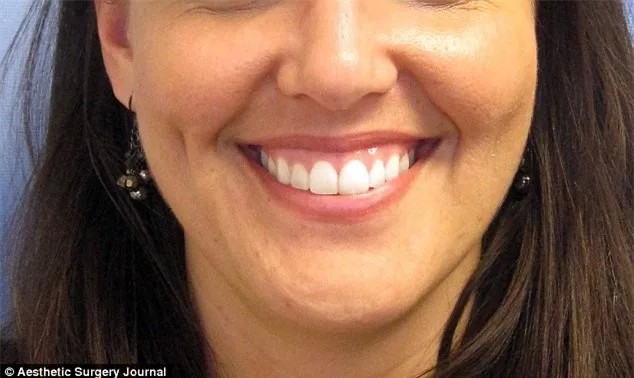 Лошадиная улыбка