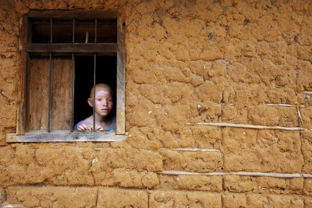Страшная доля альбиносов Танзании