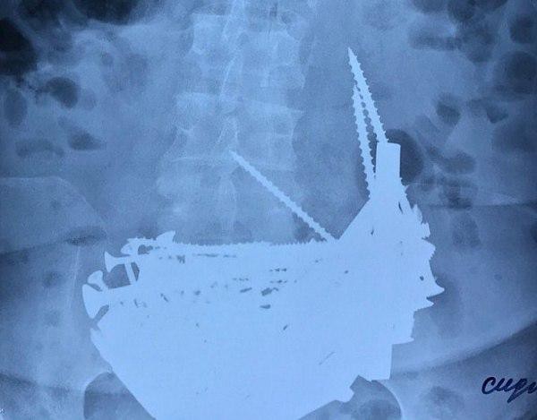 В Бурятии хирурги извлекли из желудка женщины Бурятии более 150 гвоздей, шурупов, гаек и серебряную цепочку