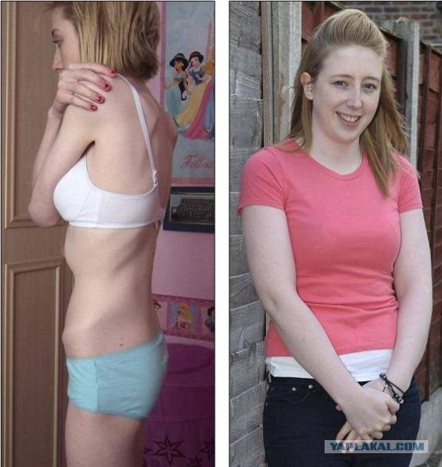 Жертвы анорексии до и после выздоровления