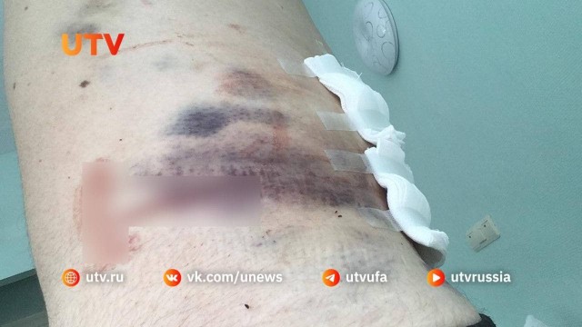 Уфа: парочка на самокате сбила прохожего. Его пришлось экстренно оперировать