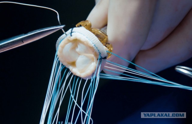 В России разработали первый в мире аортальный клапан из донорских тканей