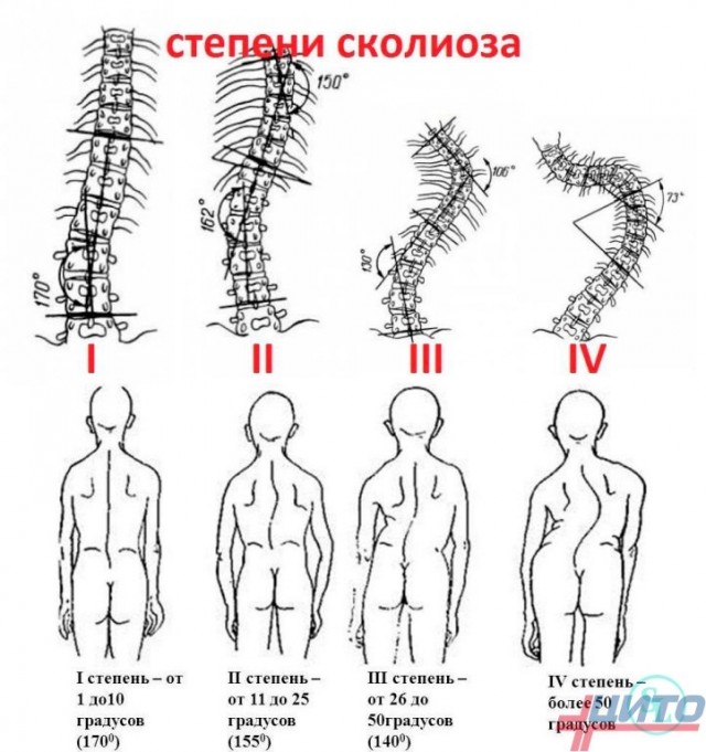 Сколиоз как выглядит на человеке Делают ли массаж при сколиозе