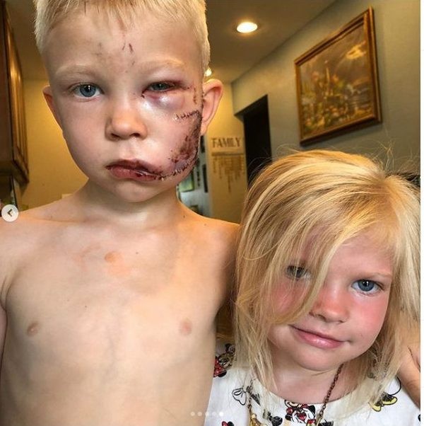 6 летний мальчик защитил сестру от собаки