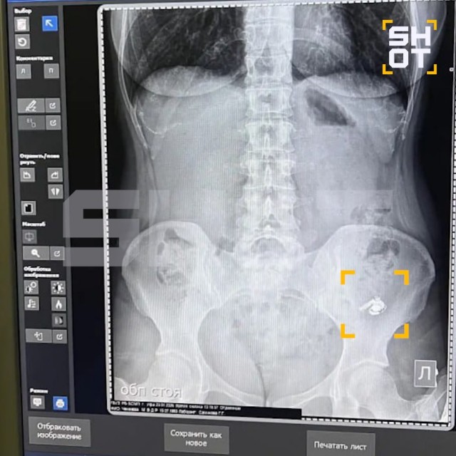 Жительница Уфы проглотила аирподс, перепутав его с таблетками. Наушник застрял в желудке на сутки