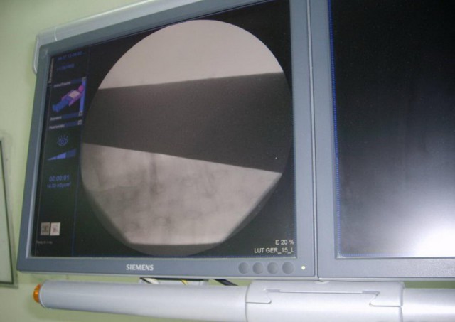 Португальский парень чудом выжил, после того как его проткнуло железякой