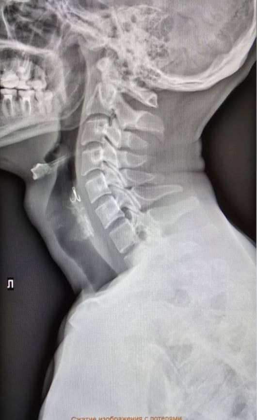 Мужчина проглотил крючок на рыбалке в Красноярске