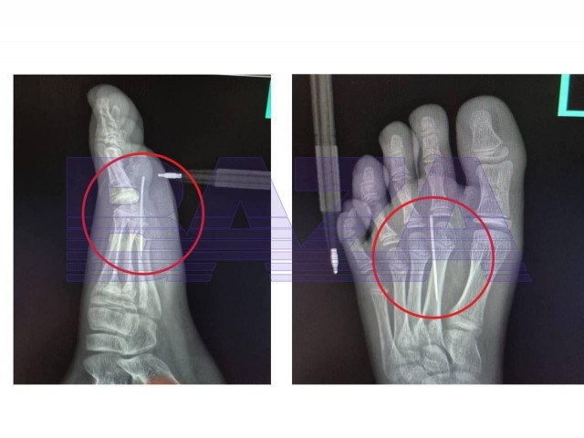 Ребенок целиком воткнул иглу себе в ногу во время «Игры в Кальмара» в Подмосковье